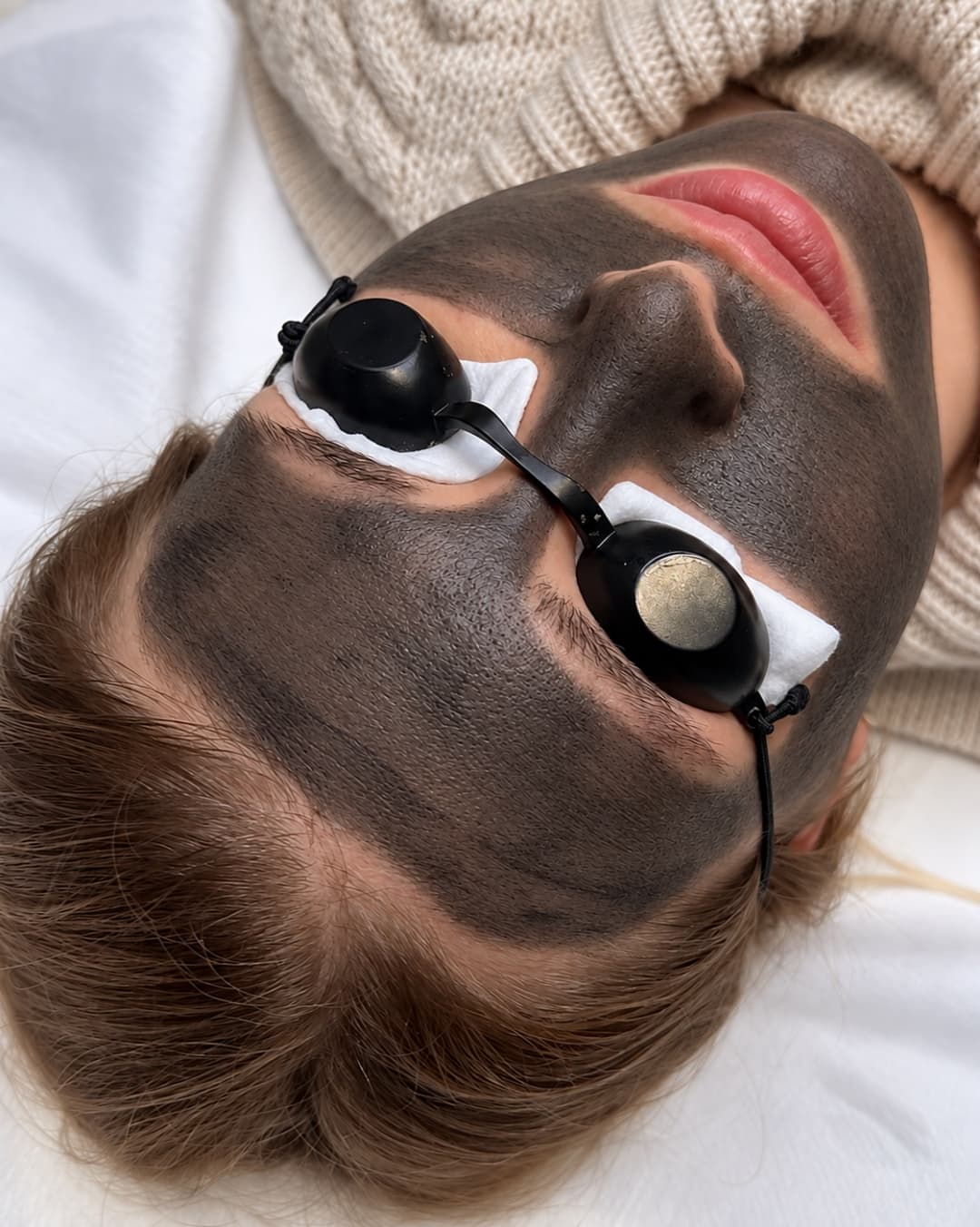 Carbon Peel – laserowy peeling węglowy